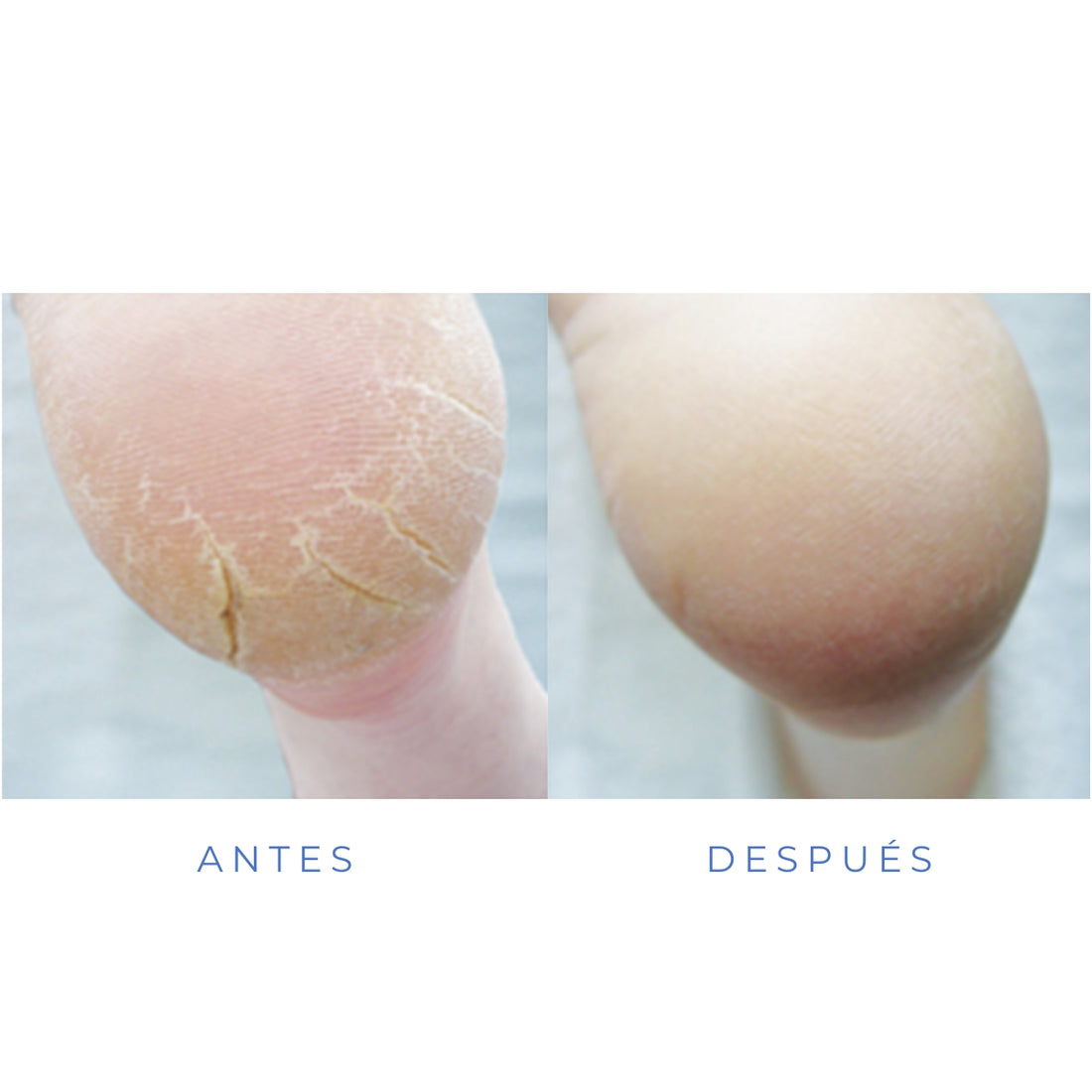 Mousse para talón agrietado 125 Ml Footlogix